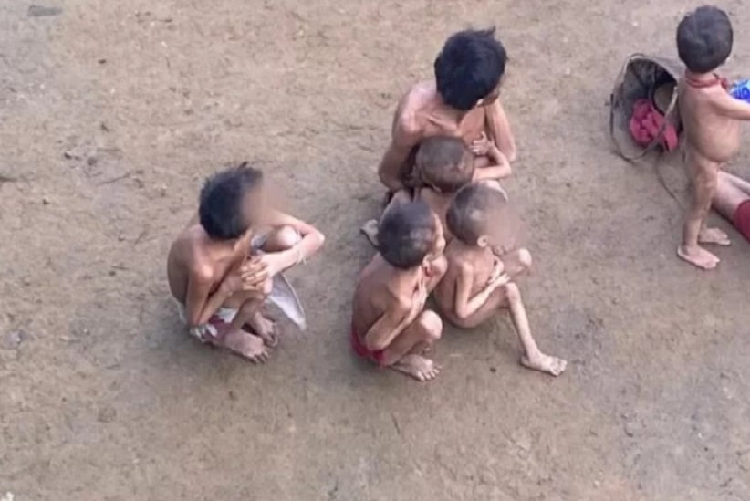 Yanomamis em estado avançado de desnutrição